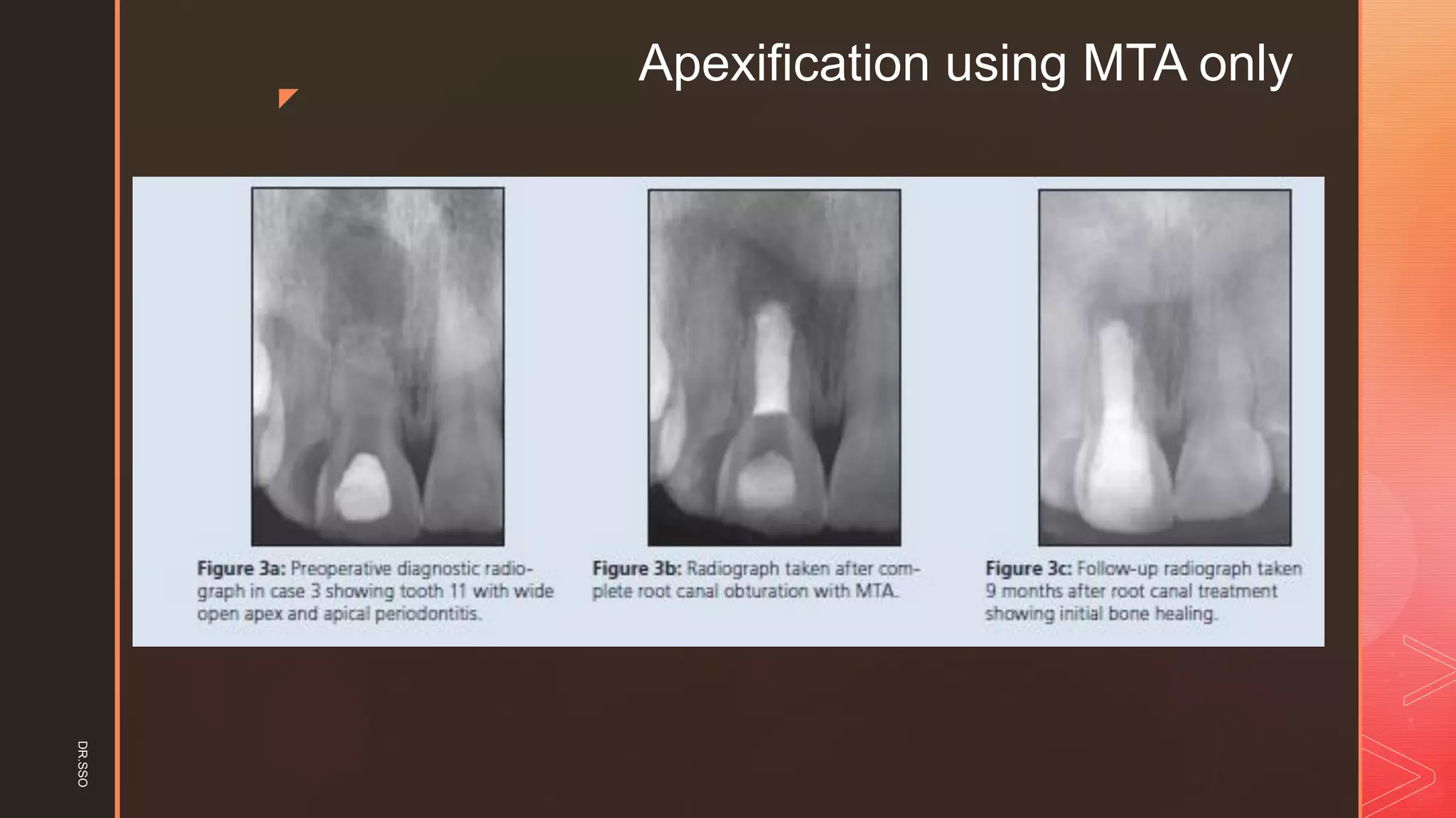 z
Apexification using MTA onlyDR.SSO
 