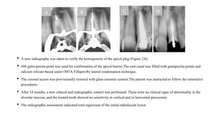 • A new radiographywas taken to verify the homogeneityof the apicalplug (Figure 2A).
• #80 gutta-percha point was used for confirmationof the apical barrier.The rootcanal was filled with guttaperchapoints and
calcium silicate-basedsealer (MTA Fillapex)bylateralcondensationtechnique.
• The coronal accesswas provisionallyrestoredwith glass ionomer cement.The patient was instructedto follow the restorative
procedures.
• After 18 months, a new clinical and radiographic control was performed. There were no clinicalsigns of abnormalityin the
alveolarmucosa, and the treatedtooth showed no sensitivityin vertical and or horizontal percussion.
• The radiographicassessment indicated totalregressionof the initialradiolucent lesion
 