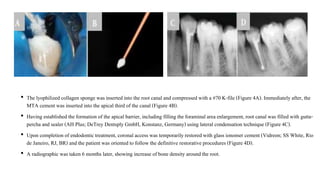 • The lyophilizedcollagen sponge was inserted into the root canal and compressedwith a #70 K-file (Figure 4A). Immediatelyafter, the
MTA cement was insertedinto the apical third of the canal (Figure 4B).
• Having established theformationof the apical barrier,including filling theforaminal area enlargement, root canal was filled with gutta-
percha and sealer (AH Plus; DeTrey Dentsply GmbH, Konstanz, Germany) using lateral condensation technique (Figure4C).
• Upon completionof endodontictreatment, coronal access was temporarilyrestoredwith glass ionomer cement (Vidreon; SS White, Rio
de Janeiro, RJ, BR) and the patient was oriented to follow the definitive restorative procedures (Figure 4D).
• A radiographic was taken 6 months later, showing increase of bone density aroundthe root.
 