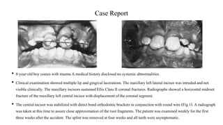Case Report
• 8-year-old boy comes with trauma A medical history disclosedno systemicabnormalities.
• Clinical examinationshowed multiple lip and gingival lacerations.The maxillary left lateral incisor was intruded and not
visible clinically.The maxillary incisorssustainedEllis Class II coronal fractures.Radiographsshowed a horizontal midroot
fracture of the maxillary left central incisor with displacement of the coronal segment.
• The central incisor was stabilizedwith direct bond orthodontic bracketsin conjunction with round wire (Fig 1). A radiograph
was taken at this time to assure close approximation of the root fragments. The patient was examined weekly for the first
three weeks after the accident.The splint was removed at four weeks and all teeth were asymptomatic.
 