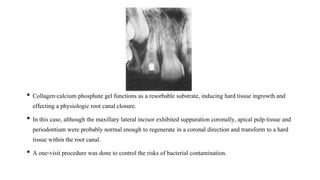 • Collagen-calcium phosphate gel functions as a resorbable substrate, inducing hard tissue ingrowth and
effecting a physiologic root canal closure.
• In this case, although the maxillary lateral incisor exhibited suppuration coronally, apical pulp tissue and
periodontium were probably normal enough to regenerate in a coronal direction and transform to a hard
tissue within the root canal.
• A one-visit procedure was done to control the risks of bacterial contamination.
 