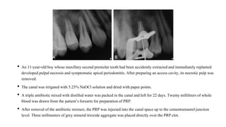 • An 11-year-old boy whose maxillary second premolar tooth had been accidently extractedand immediately replanted
developed pulpal necrosisand symptomatic apical periodontitis.After preparing an access cavity, its necrotic pulp was
removed.
• The canal was irrigated with 5.25% NaOCl solution and dried with paper points.
• A triple antibioticmixed with distilledwater was packed in the canal and left for 22 days. Twenty millilitersof whole
blood was drawn from the patient’sforearm for preparation of PRP.
• After removal of the antibiotic mixture, the PRP was injected into the canal space up to the cementoenamel junction
level. Three millimetersof grey mineral trioxide aggregate was placed directly over the PRP clot.
 