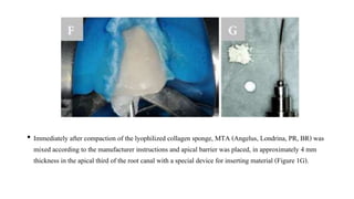 • Immediately after compaction of the lyophilized collagen sponge, MTA (Angelus, Londrina, PR, BR) was
mixed according to the manufacturer instructions and apical barrier was placed, in approximately 4 mm
thickness in the apical third of the root canal with a special device for inserting material (Figure 1G).
 