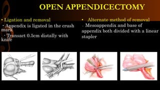 OPEN APPENDICECTOMY
• Ligation and removal
- Appendix is ligated in the crush
mark
- Transact 0.5cm distally with
knife
• Alternate method of removal
- Mesoappendix and base of
appendix both divided with a linear
stapler
 
