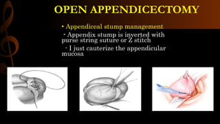 OPEN APPENDICECTOMY
• Appendiceal stump management
- Appendix stump is inverted with
purse string suture or Z stitch
- I just cauterize the appendicular
mucosa
 