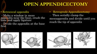 OPEN APPENDICECTOMY
• Retrocecal appendix
- Make a window in meso
appendix near the base, crush the
base and apply ligature
- Divide the appendix at the base
first
• Retrograde Appendicectomy
- Then serially clamp the
mesoappendix and divide until you
reach the tip of appendix
 