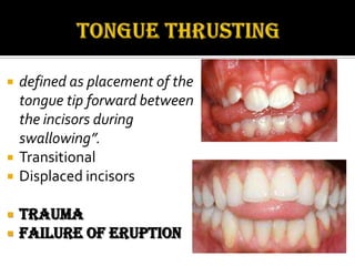 







defined as placement of the
tongue tip forward between
the incisors during
swallowing”.
Transitional
Displaced incisors

Trauma
Failure of eruption

 