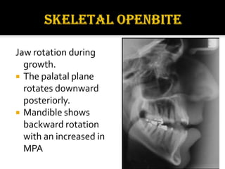 Jaw rotation during
growth.
 The palatal plane
rotates downward
posteriorly.
 Mandible shows
backward rotation
with an increased in
MPA

 