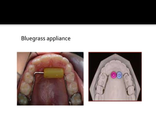 Bluegrass appliance

 