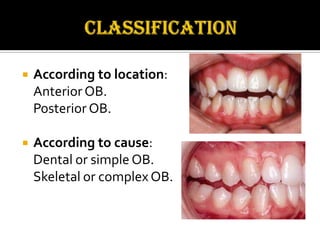 

According to location:
Anterior OB.
Posterior OB.



According to cause:
Dental or simple OB.
Skeletal or complex OB.

 