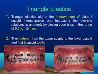 Bio mechanical considerations of Open bite. Dr. Ajay | PPT