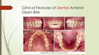 Clinical Features of Dental Anterior
Open Bite
 
