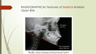 RADIOGRAPHICAL Features of Skeletal Anterior
Open Bite
 