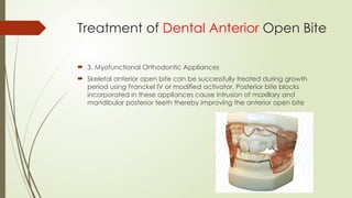  3. Myofunctional Orthodontic Appliances
 Skeletal anterior open bite can be successfully treated during growth
period using Franckel IV or modified activator. Posterior bite blocks
incorporated in these appliances cause intrusion of maxillary and
mandibular posterior teeth thereby improving the anterior open bite
Treatment of Dental Anterior Open Bite
 