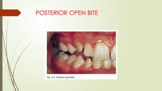 POSTERIOR OPEN BITE
 