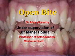 Opebite Open bite | PPT