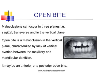 OPEN BITE
Malocclusions can occur in three planes i,e.
sagittal, transverse and in the vertical plane.
Open bite is a malocclusion in the vertical
plane, characterized by lack of vertical
overlap between the maxillary and
mandibular dentition.
It may be an anterior or a posterior open bite.
www.indiandentalacademy.com
 