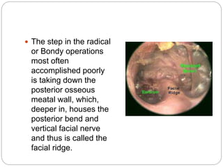  The step in the radical
or Bondy operations
most often
accomplished poorly
is taking down the
posterior osseous
meatal wall, which,
deeper in, houses the
posterior bend and
vertical facial nerve
and thus is called the
facial ridge.
 
