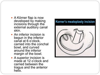  A Körner flap is now
developed by making
incisions through the
external auditory canal
skin.
 An inferior incision is
begun in the inferior
canal at 6 o’clock,
carried into the conchal
bowl, and curved
around the inferior
margin of the bowl.
 A superior incision is
made at 12 o’clock and
carried between the
tragus and the anterior
helix.
 