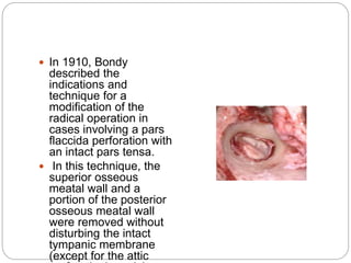  In 1910, Bondy
described the
indications and
technique for a
modification of the
radical operation in
cases involving a pars
flaccida perforation with
an intact pars tensa.
 In this technique, the
superior osseous
meatal wall and a
portion of the posterior
osseous meatal wall
were removed without
disturbing the intact
tympanic membrane
(except for the attic
 