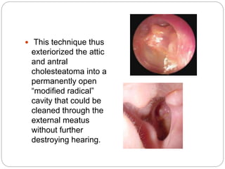  This technique thus
exteriorized the attic
and antral
cholesteatoma into a
permanently open
“modified radical”
cavity that could be
cleaned through the
external meatus
without further
destroying hearing.
 