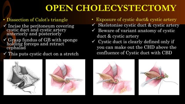 Open cholecystectomy/ operative surgery | PPTX | Lung and Respiratory ...