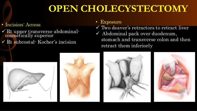 Open cholecystectomy/ operative surgery
