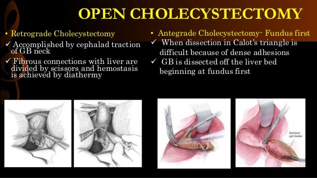 Open cholecystectomy/ operative surgery