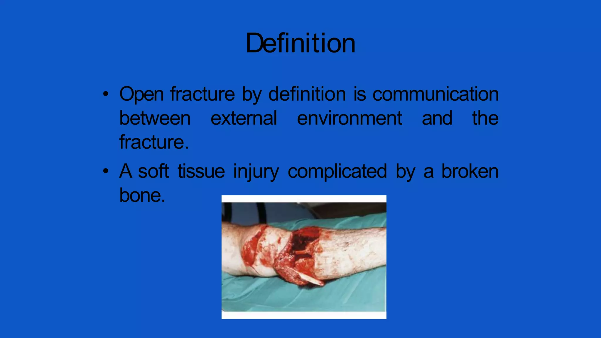Open fracture management | PPT