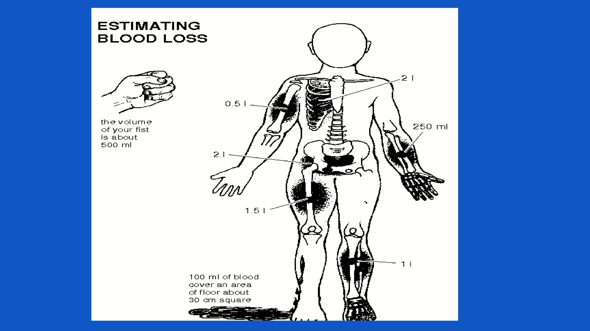 Open fracture management | PPTX