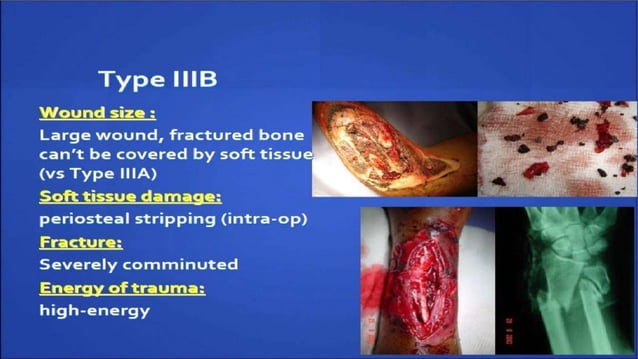 Open fracture management | PPTX