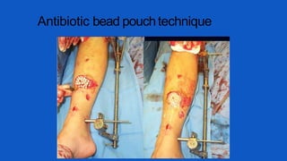 Antibiotic bead pouchtechnique
 