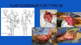 FLAPCOVERAGE FOR TYPE 3B
 