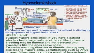 Hypovolemic shock
 