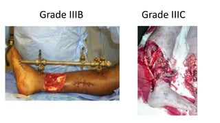 Grade IIIB Grade IIIC
 