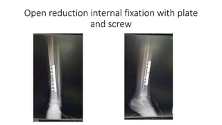 Open reduction internal fixation with plate
and screw
 