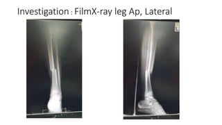 Investigation : FilmX-ray leg Ap, Lateral
 