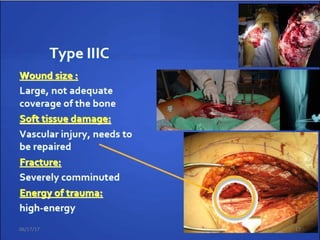 Nerve
 Sensate No major nerve
injury
1
 Dorsal Deep peroneal
nerve
2
 Plantar partial Tibial nerve injury 3
 Plantar complete Sciatic nerve 4
Ischemia
 None Good to fair pulses,
no ischemia
0
 Mild Decreased pulses
perfusion
1
 Moderate Prolonged capillary
refill, Doppler
pulses fill
2
 Severe Pulseless, cool,
ischemic, no
doppler
3
Soft Tissue
 Grade I Minimal
contamination
0
 Grade II Moderate soft
tissue injury, low
velocity
1
 Grade IIIA Moderate crush
injury, high velocity
with Considerable
contamination
2
 Grade IIIB Massive crush
injury severe
contamination
3
Skeletal
 Spiral or oblique
fracture
0
 Transverse
fracture-minimal
contamination
1
 Moderate
displacement and
communition with
high velocity
2
 Segmental
fracture, severe
communition, bony
loss
3
Shock
 Normotensive 0
 Transient
hypotensive
1
 Persistent
hypotensive
2
06/17/17 17
 