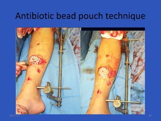 Antibiotic bead pouch technique
06/17/17 38
 