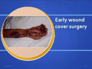 Open wound coverage after primary
surgery
06/17/17 55
 