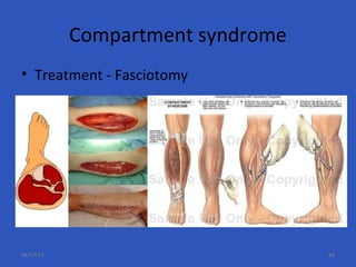Compartment syndrome
• Treatment - Fasciotomy
06/17/17 68
 