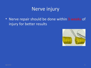Nerve injury
• Nerve repair should be done within 3 weeks of
injury for better results
06/17/17 75
 