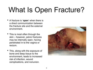 What Is Open Fracture?
• A fracture is ‘open’ when there is
a direct communication between
the fracture site and the external
environment.
• This is most often through the
skin – however, pelvic fractures
may be internally open, having
penetrated in to the vagina or
rectum.
• This, along with the exposure of
bone and deep tissue to the
environment, leads to increased
risk of infection, wound
complications, and nonunion.
3
 