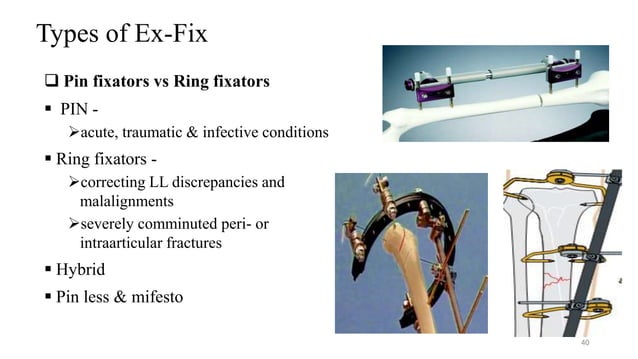 OPEN FRACTURE MANAGEMENT AND PRINCIPLE OF EXTERNAL FIXATION.pptx