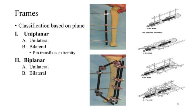 OPEN FRACTURE MANAGEMENT AND PRINCIPLE OF EXTERNAL FIXATION.pptx
