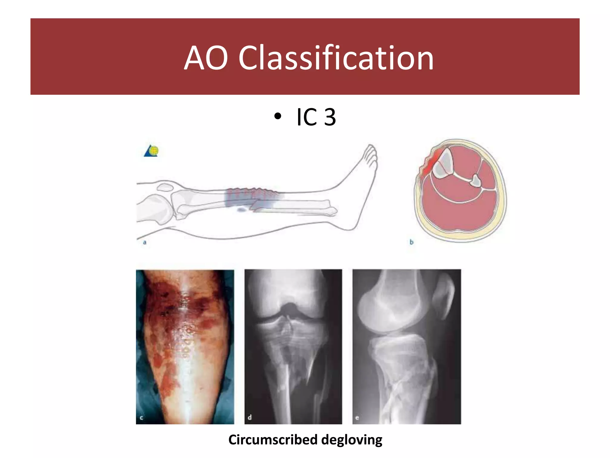 • IC 3
AO Classification
Circumscribed degloving
 