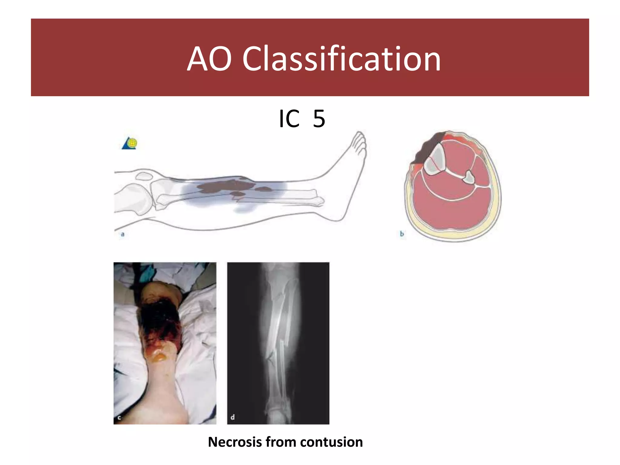 IC 5
AO Classification
Necrosis from contusion
 