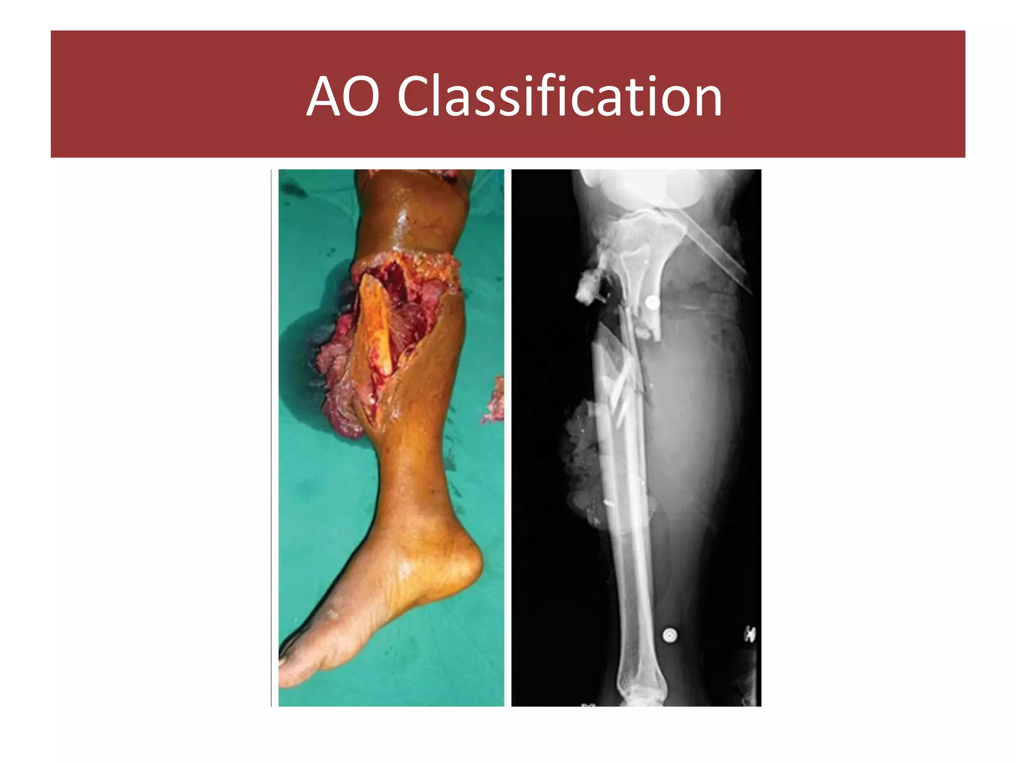 AO Classification
 