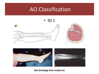 • IO 1
AO Classification
Skin breakage from inside out
 