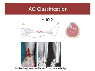 • IO 2
AO Classification
Skin breakage from outside in < 5 cm, contused edges
 
